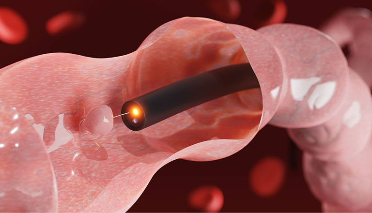 日帰りポリープ切除